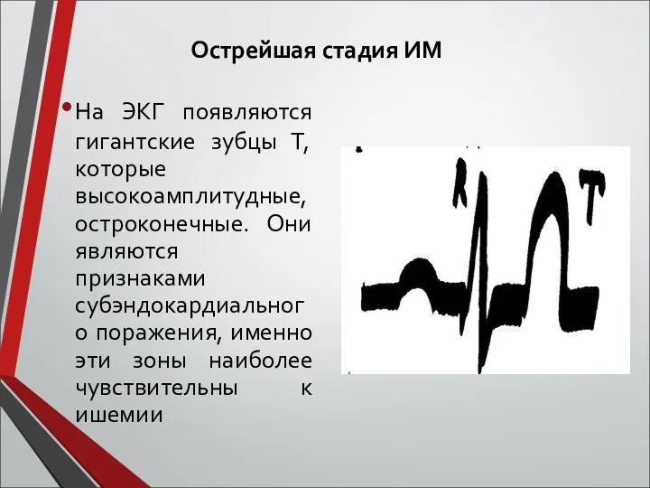 Острейшая стадия ИМ На ЭКГ появляются гигантские зубцы Т, которые высокоамплитудные,