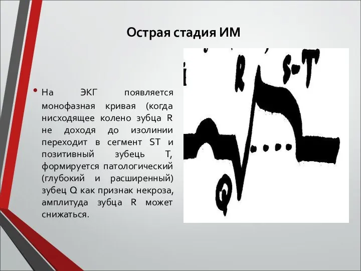 Острая стадия ИМ На ЭКГ появляется монофазная кривая (когда нисходящее колено