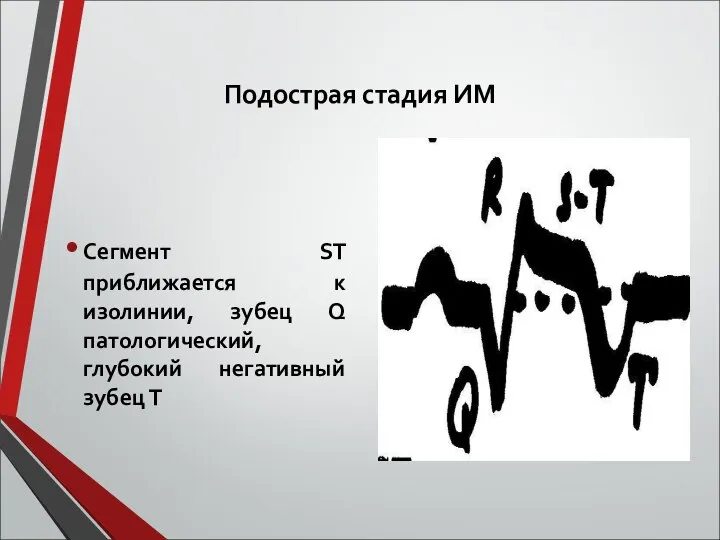 Подострая стадия ИМ Сегмент ST приближается к изолинии, зубец Q патологический, глубокий негативный зубец Т