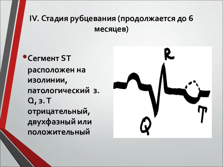 ІV. Стадия рубцевания (продолжается до 6 месяцев) Сегмент ST расположен на