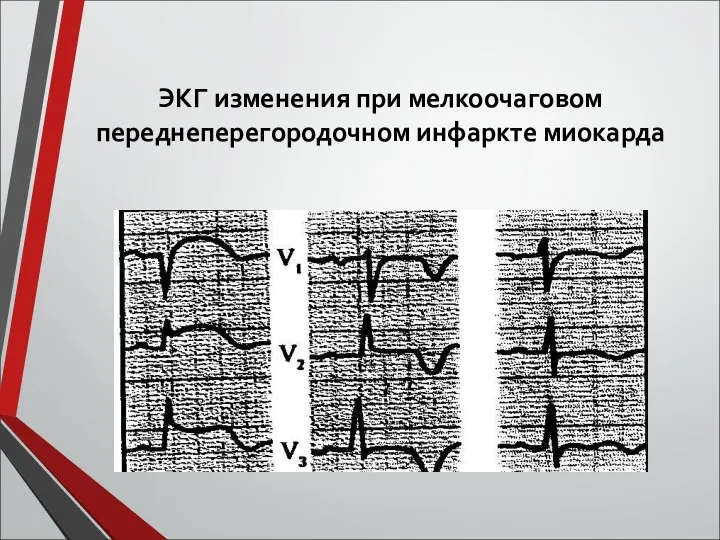 ЭКГ изменения при мелкоочаговом переднеперегородочном инфаркте миокарда