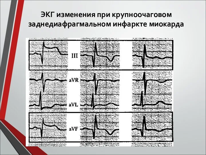 ЭКГ изменения при крупноочаговом заднедиафрагмальном инфаркте миокарда