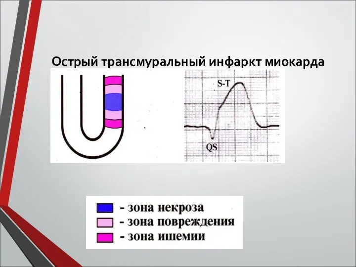 Острый трансмуральный инфаркт миокарда