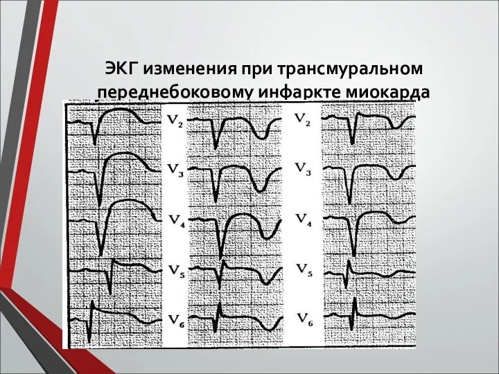 ЭКГ изменения при трансмуральном переднебоковому инфаркте миокарда