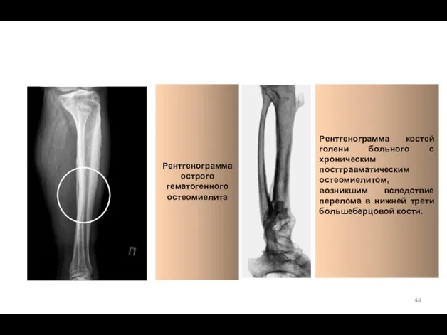 Рентгенограмма острого гематогенного остеомиелита Рентгенограмма костей голени больного с хроническим посттравматическим