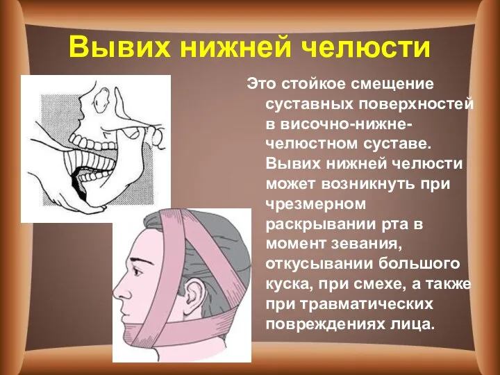 Вывих нижней челюсти Это стойкое смещение суставных поверхностей в височно-нижне-челюстном суставе.