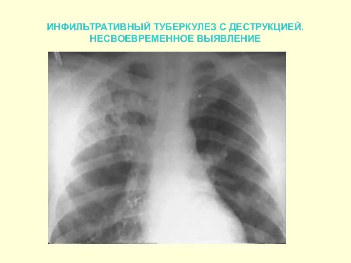 ИНФИЛЬТРАТИВНЫЙ ТУБЕРКУЛЕЗ С ДЕСТРУКЦИЕЙ. НЕСВОЕВРЕМЕННОЕ ВЫЯВЛЕНИЕ