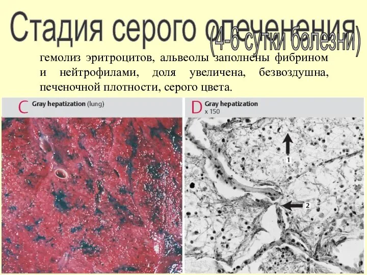 Стадия серого опеченения (4-6 сутки болезни) гемолиз эритроцитов, альвеолы заполнены фибрином