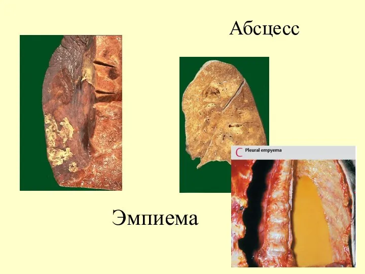 Эмпиема Абсцесс