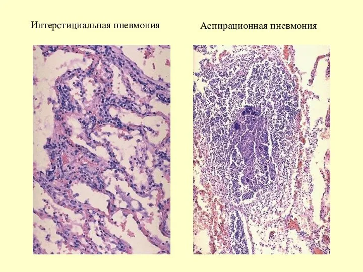 Интерстициальная пневмония Аспирационная пневмония