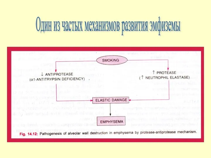 Один из частых механизмов развития эмфиземы