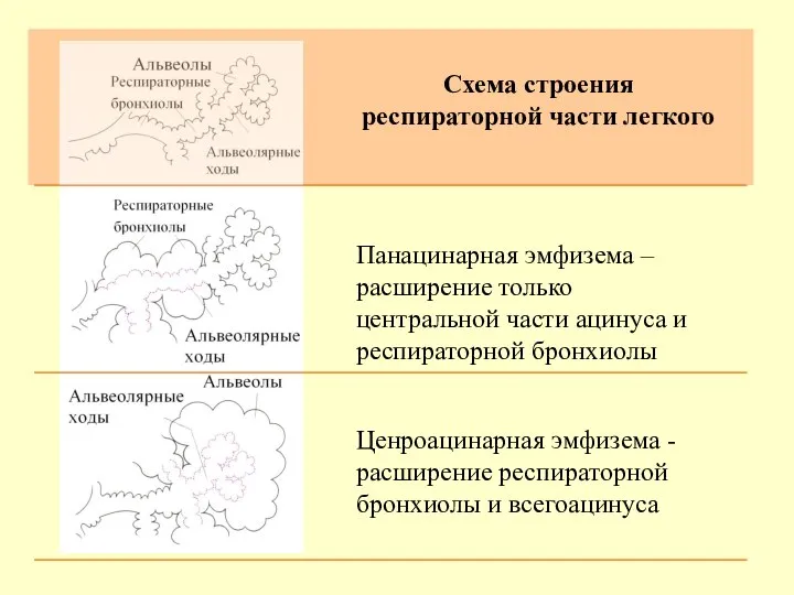 Панацинарная эмфизема – расширение только центральной части ацинуса и респираторной бронхиолы