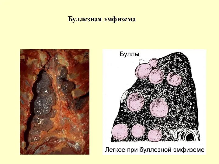 Буллезная эмфизема