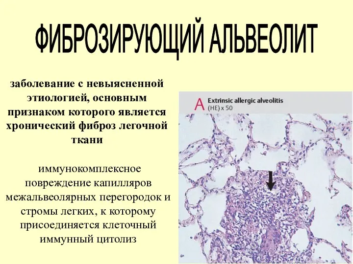 ФИБРОЗИРУЮЩИЙ АЛЬВЕОЛИТ заболевание с невыясненной этиологией, основным признаком которого является хронический