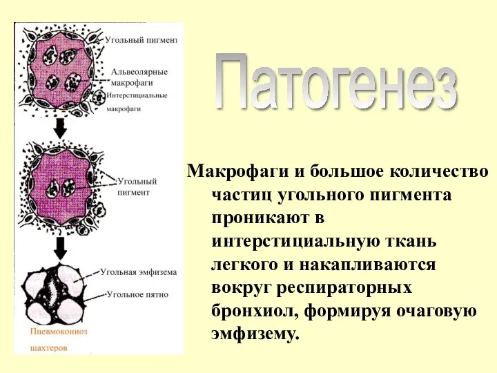 Макрофаги и большое количество частиц угольного пигмента проникают в интерстициальную ткань