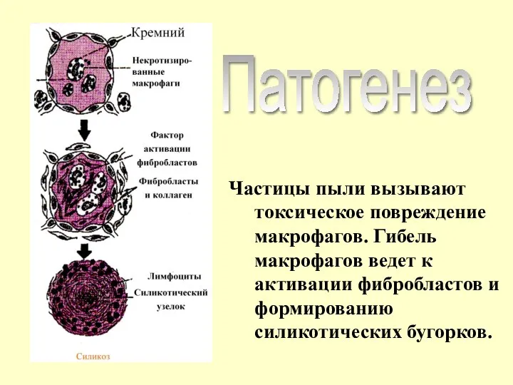 Частицы пыли вызывают токсическое повреждение макрофагов. Гибель макрофагов ведет к активации