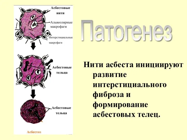 Нити асбеста инициируют развитие интерстициального фиброза и формирование асбестовых телец. Патогенез