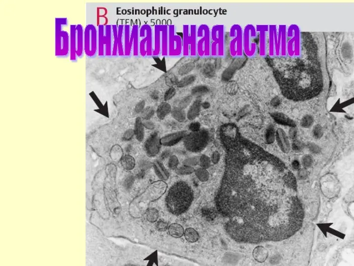 Бронхиальная астма