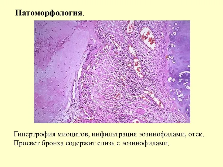 Патоморфология. Гипертрофия миоцитов, инфильтрация эозинофилами, отек. Просвет бронха содержит слизь с эозинофилами.