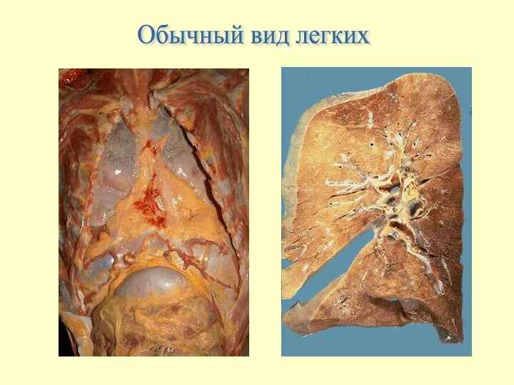 Обычный вид легких