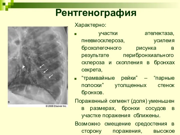 Характерно: участки ателектаза, пневмосклероза, усилеия брохолегочного рисунка в результате перибронхиального склероза