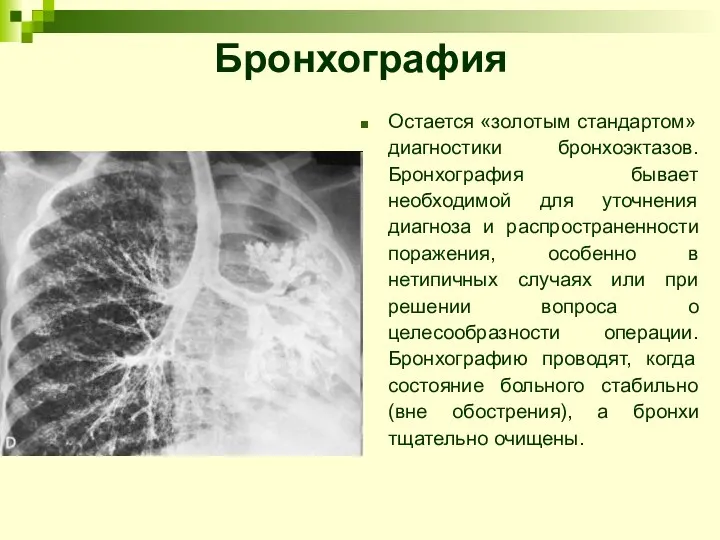 Бронхография Остается «золотым стандартом» диагностики бронхоэктазов. Бронхография бывает необходимой для уточнения