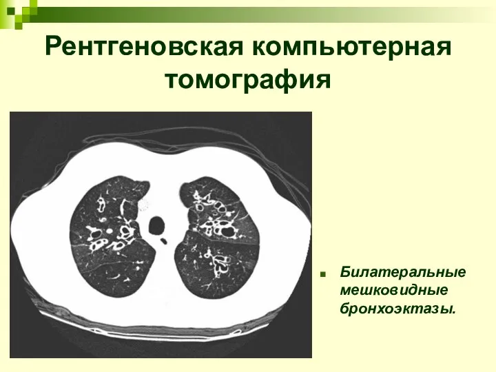 Билатеральные мешковидные бронхоэктазы. Рентгеновская компьютерная томография