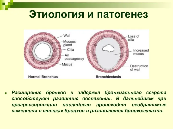 Этиология и патогенез Расширение бронхов и задержка бронхиального секрета способствуют развитию