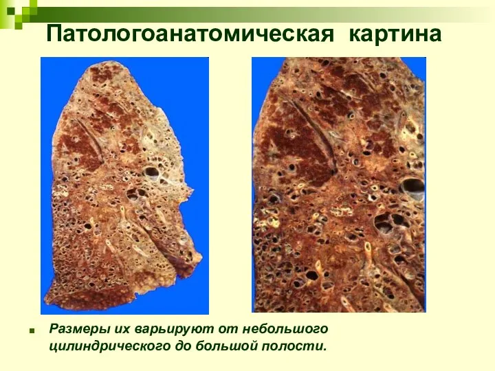 Патологоанатомическая картина Размеры их варьируют от небольшого цилиндрического до большой полости.