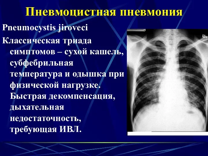 Пневмоцистная пневмония Pneumocystis jiroveci Классическая триада симптомов – сухой кашель, субфебрильная