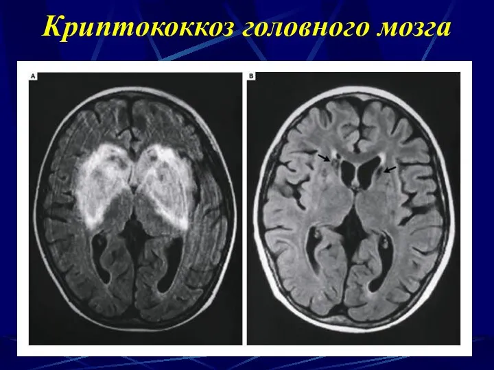 Криптококкоз головного мозга