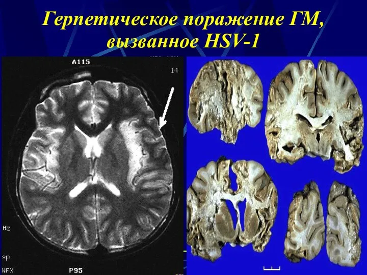 Герпетическое поражение ГМ, вызванное HSV-1