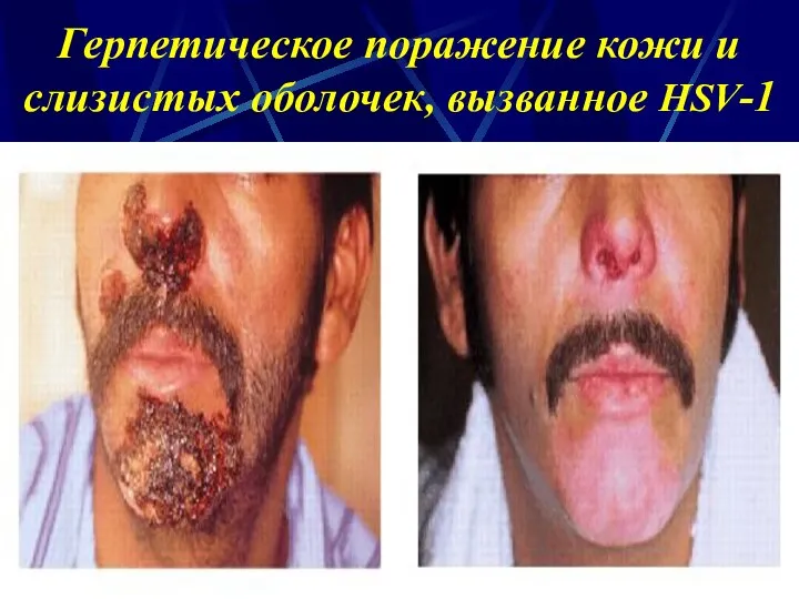 Герпетическое поражение кожи и слизистых оболочек, вызванное HSV-1