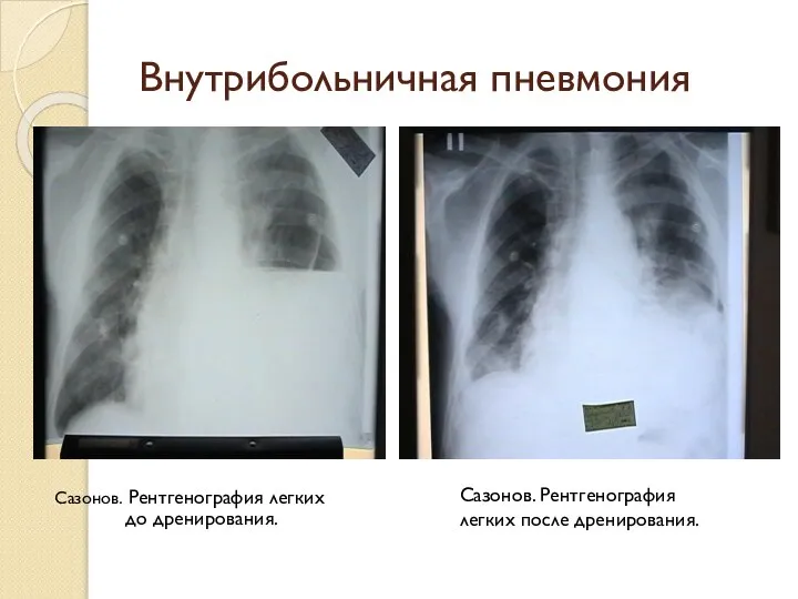 Внутрибольничная пневмония Сазонов. Рентгенография легких до дренирования. Сазонов. Рентгенография легких после дренирования.