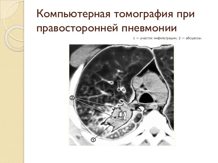 Компьютерная томография при правосторонней пневмонии