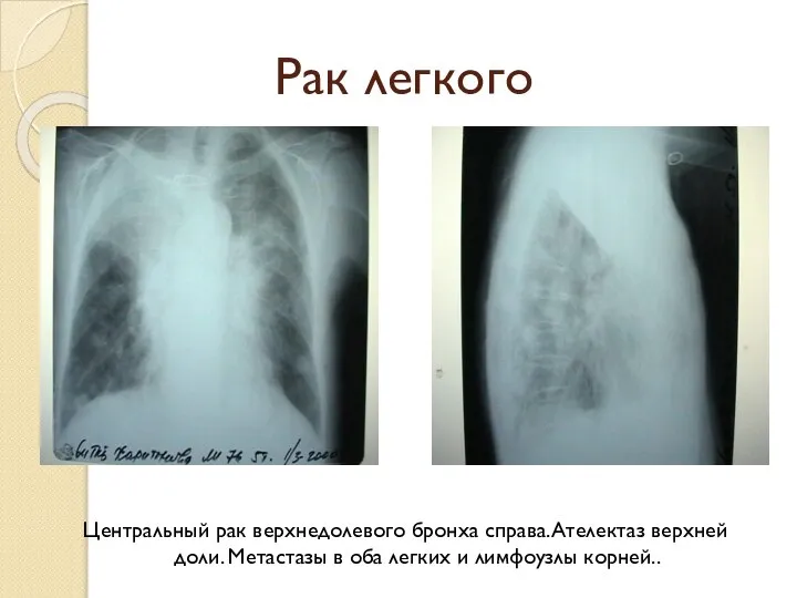 Рак легкого Центральный рак верхнедолевого бронха справа.Ателектаз верхней доли. Метастазы в оба легких и лимфоузлы корней..