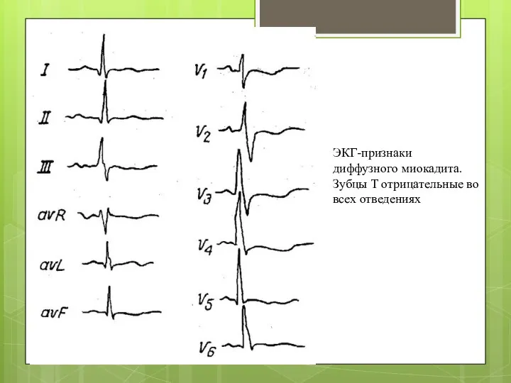 ЭКГ-признаки диффузного миокадита.Зубцы Т отрицательные во всех отведениях