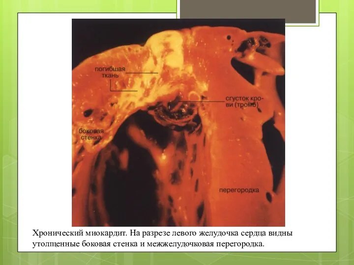 Хронический миокардит. На разрезе левого желудочка сердца видны утолщенные боковая стенка и межжелудочковая перегородка.