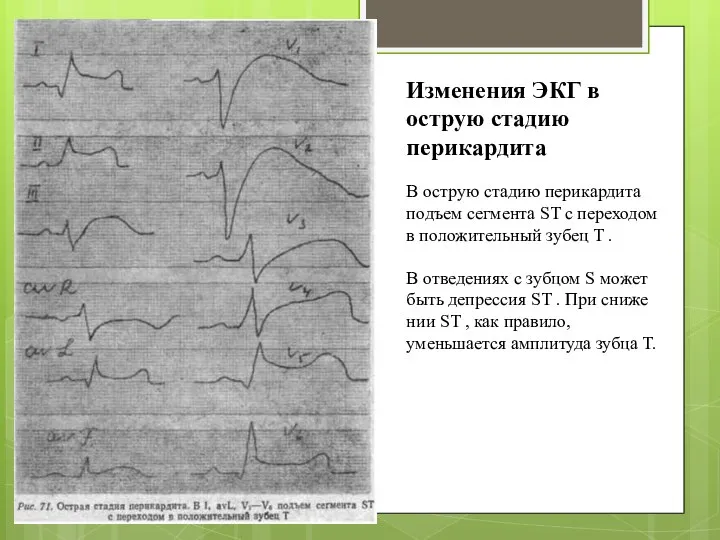 В острую стадию перикардита подъем сегмента ST с переходом в положительный