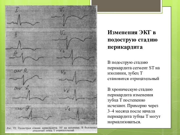 В подострую стадию перикардита сегмент ST на изолинии, зу­бец Т становится