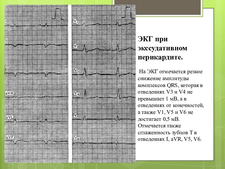 ЭКГ при экссудативном перикардите. На ЭКГ отмечается резкое снижение амплитуды комплексов