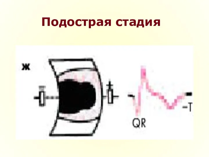 Подострая стадия