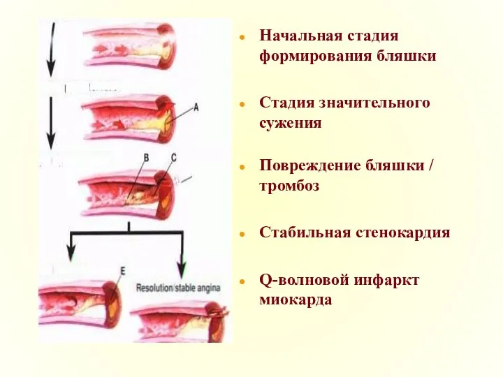 Начальная стадия формирования бляшки Стадия значительного сужения Повреждение бляшки / тромбоз Стабильная стенокардия Q-волновой инфаркт миокарда