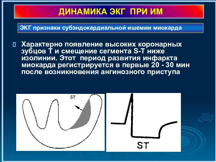 ДИНАМИКА ЭКГ ПРИ ИМ Характерно появление высоких коронарных зубцов Т и