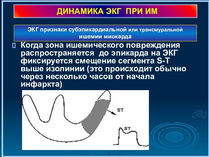 ДИНАМИКА ЭКГ ПРИ ИМ Когда зона ишемического повреждения распространяется до эпикарда