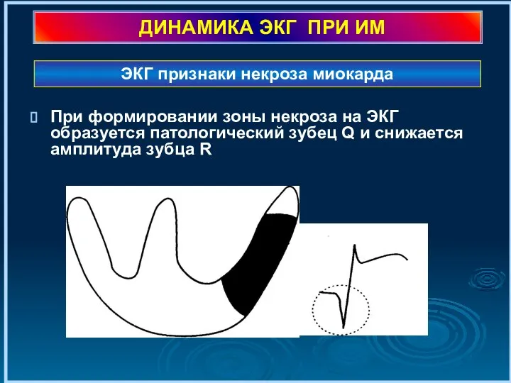 ДИНАМИКА ЭКГ ПРИ ИМ При формировании зоны некроза на ЭКГ образуется