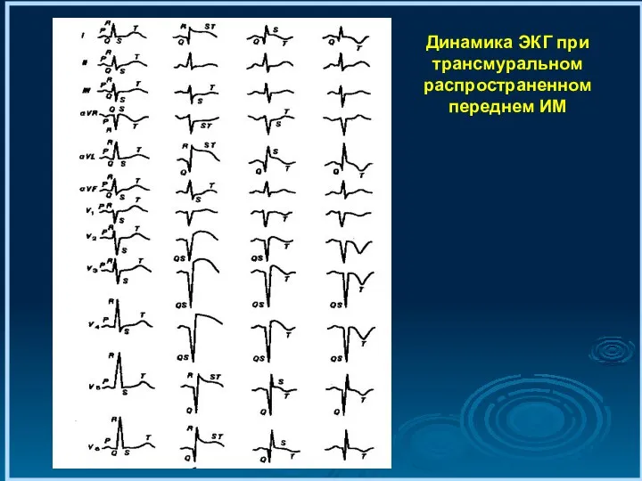 Динамика ЭКГ при трансмуральном распространенном переднем ИМ