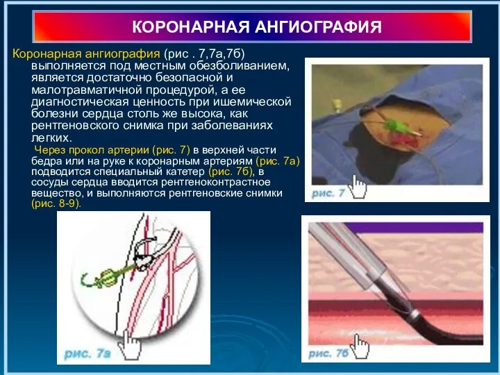 КОРОНАРНАЯ АНГИОГРАФИЯ Коронарная ангиография (рис . 7,7а,7б) выполняется под местным обезболиванием,