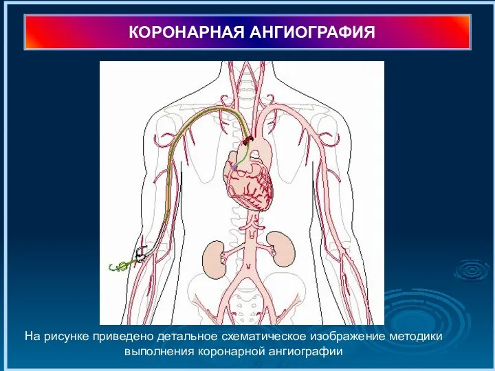 КОРОНАРНАЯ АНГИОГРАФИЯ На рисунке приведено детальное схематическое изображение методики выполнения коронарной ангиографии