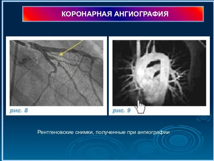 КОРОНАРНАЯ АНГИОГРАФИЯ Рентгеновские снимки, полученные при ангиографии